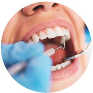 tooth removal