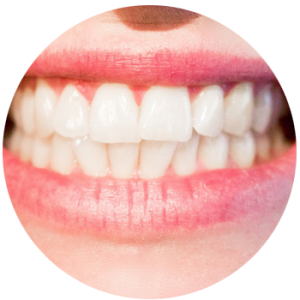 teeth whitening